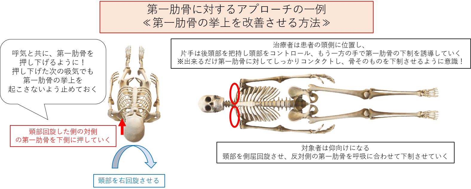 胸郭出口症候群はどのように治療されますか?